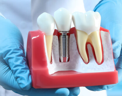 Dental Implants After-Care Guide: Excel Dental Care 
