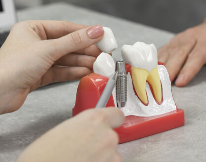 Dental Implants: Procedure Types and Materials 