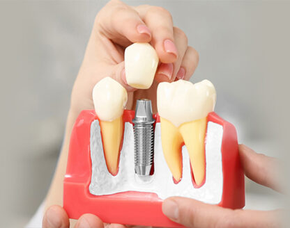 A Detailed Look at Dental Implant Healing Stages and Aftercare 