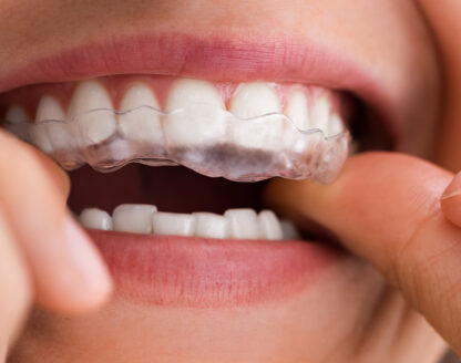 Can Invisalign Fix Crowding? A Comprehensive Guide 
