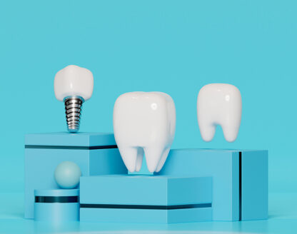 Dental Implant Abutment: A Key Step in the Implant Process 