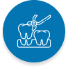 Cantilever Dental Bridge